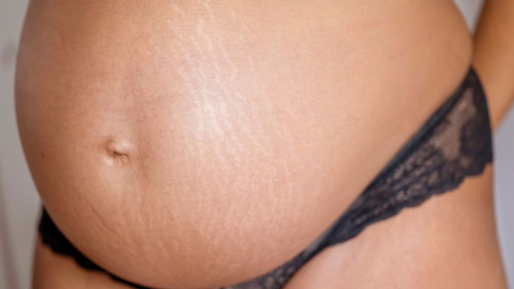 Pregnancy Stretch Marks Woman - symmetrica Blog
